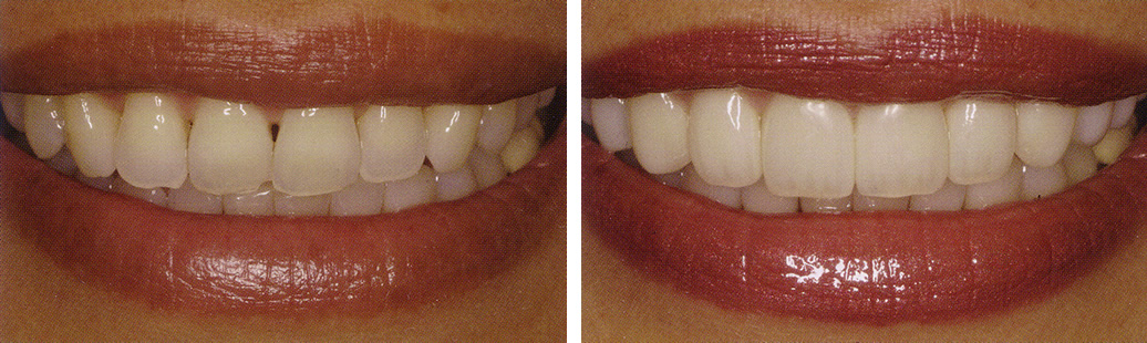 Gap Teeth Before And After. Teeth that are chipped,
