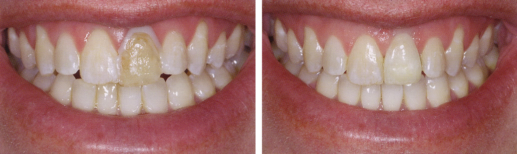 Porcelain Crowns