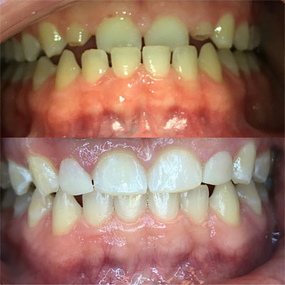 Invisalign Case #1 in Cranbury, NJ