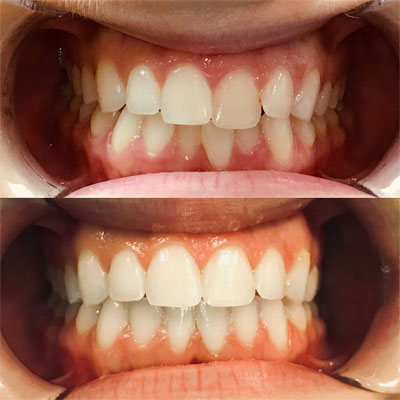 Invisalign Case #2 in Cranbury, NJ