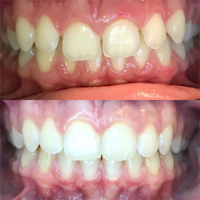 Invisalign Case #3 in Cranbury, NJ