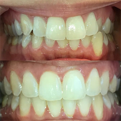 Invisalign Case #4 in Cranbury, NJ